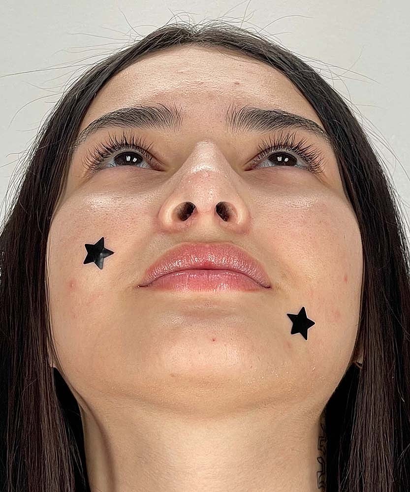 Rhinoplasty Before & After