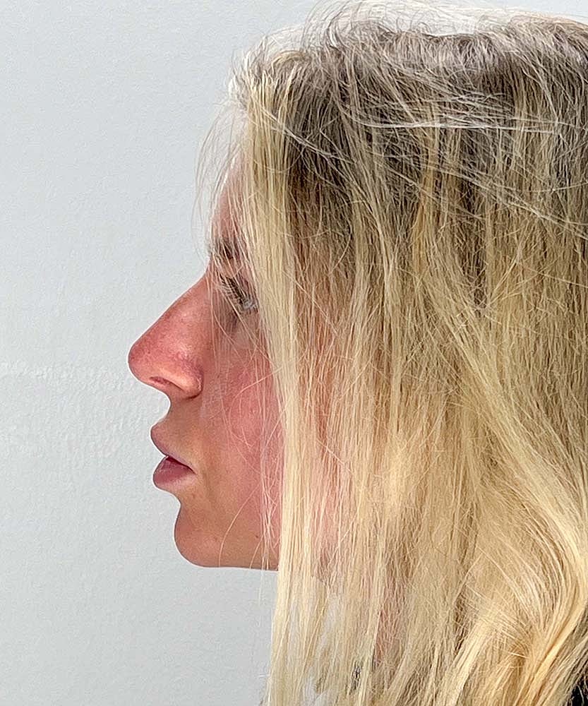 Rhinoplasty Before & After