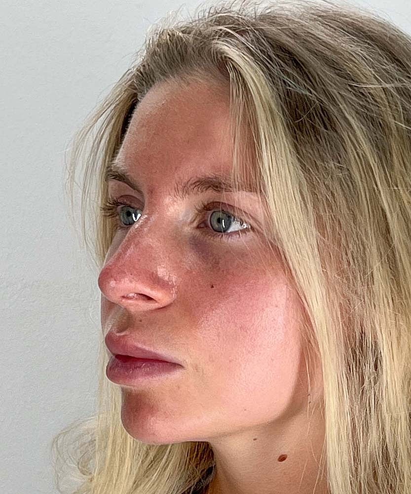 Rhinoplasty Before & After