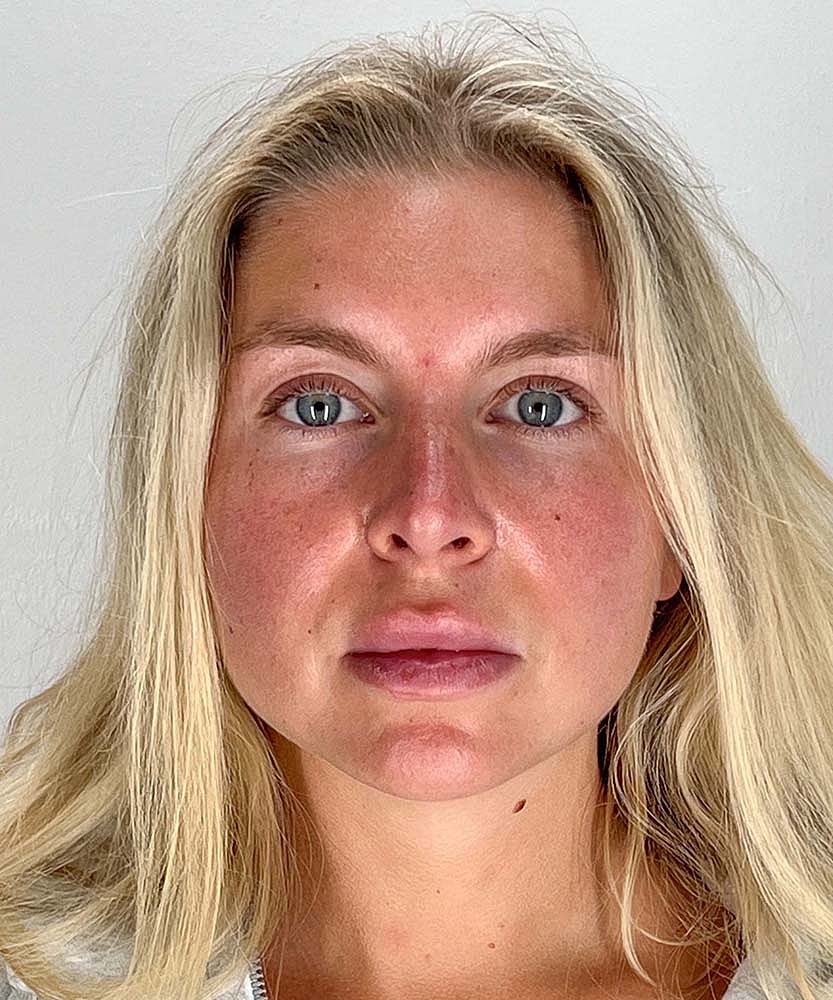 Rhinoplasty Before & After