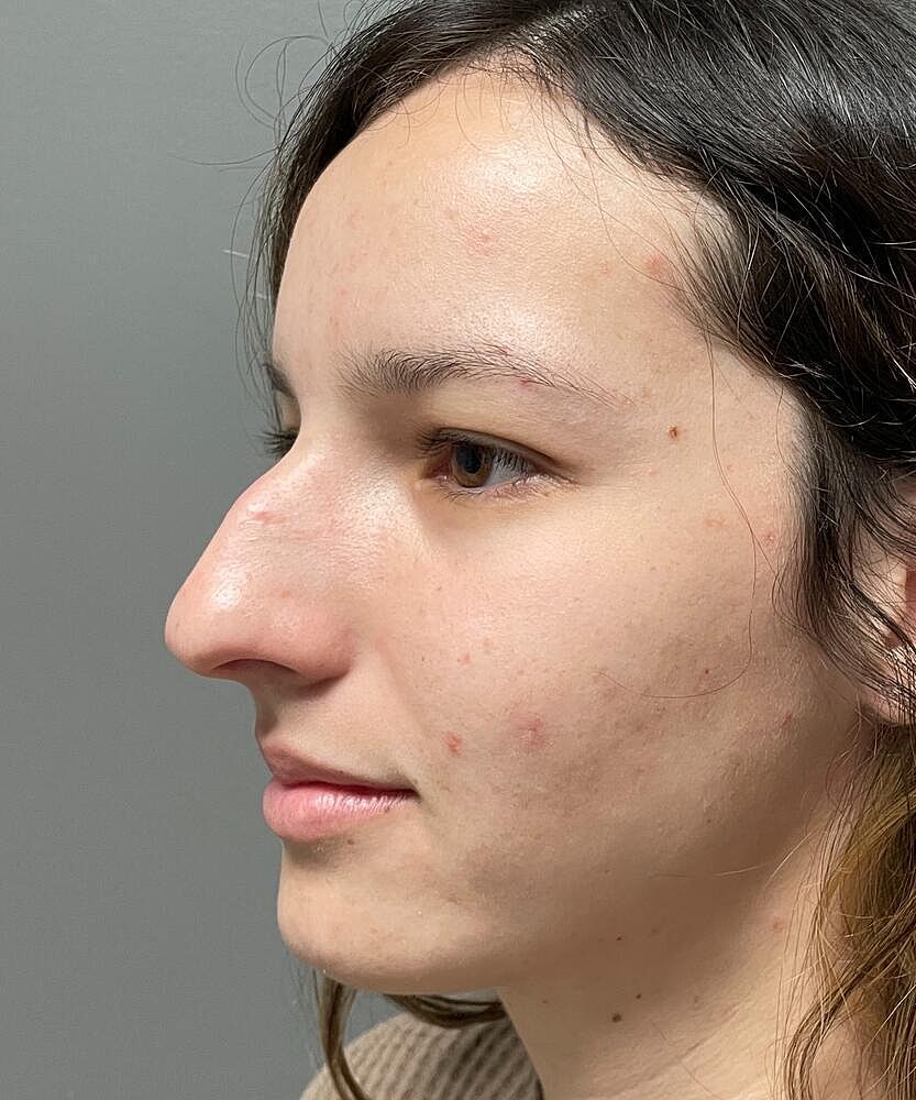 Rhinoplasty Before & After