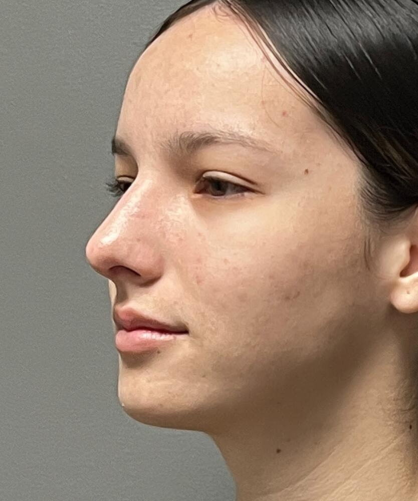 Rhinoplasty Before & After
