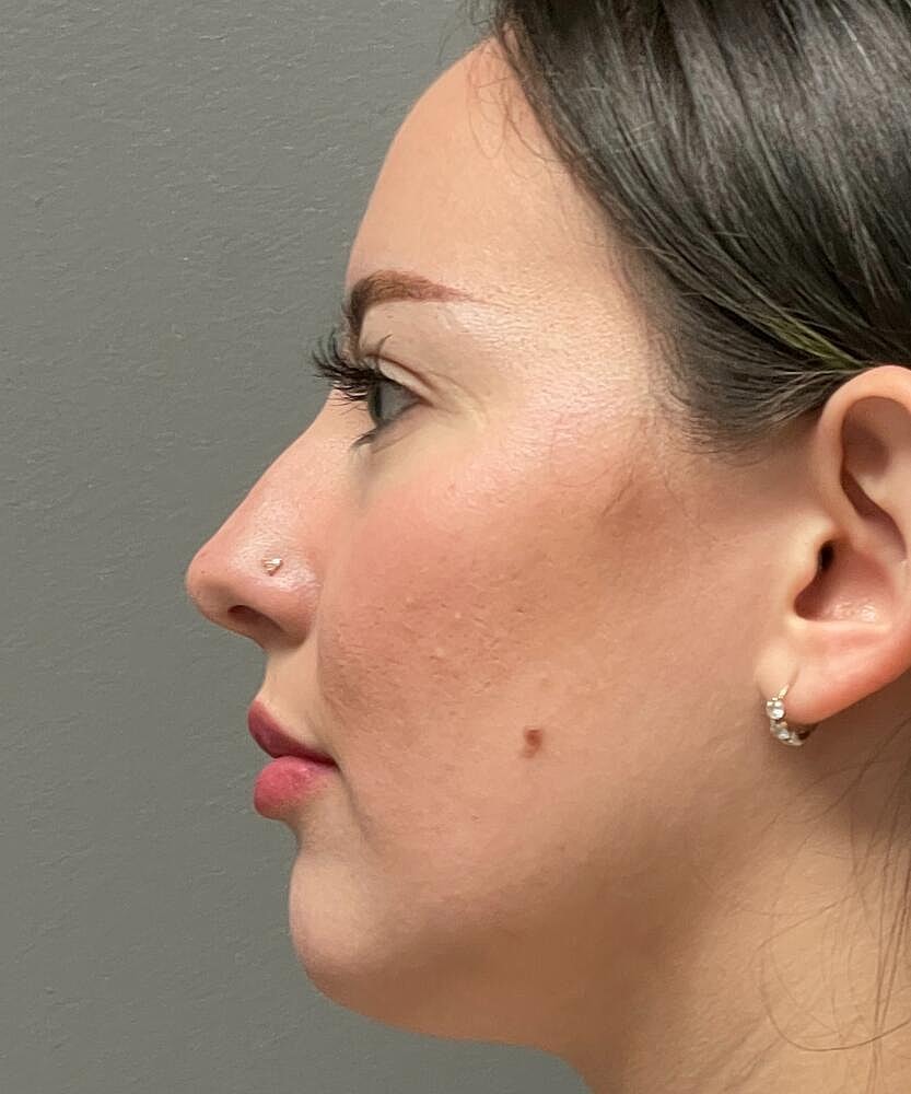 Rhinoplasty Before & After