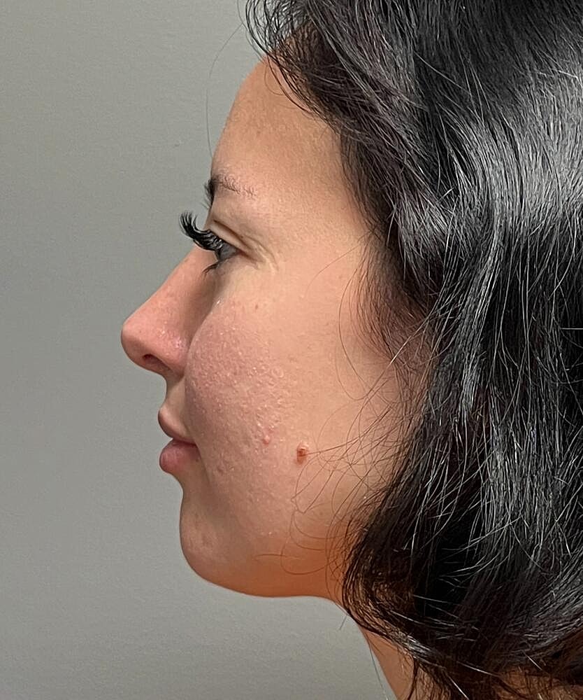 Rhinoplasty Before & After