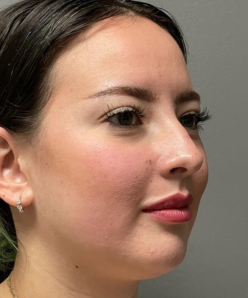 Rhinoplasty Before & After