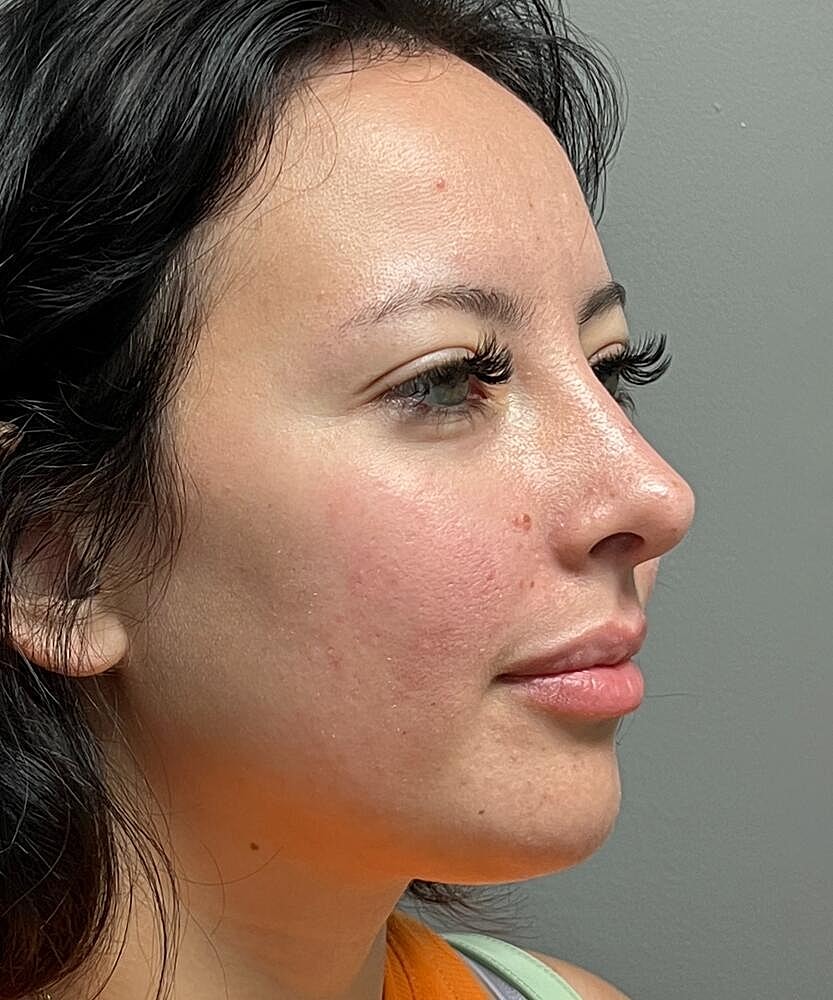 Rhinoplasty Before & After