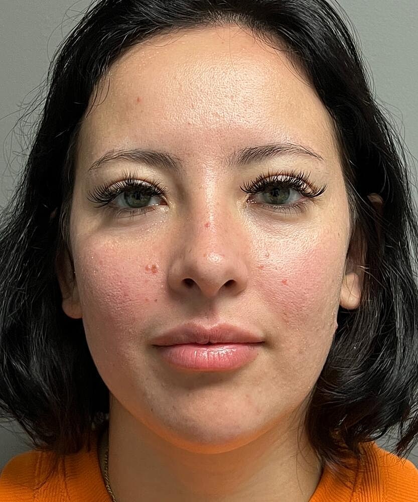 Rhinoplasty Before & After