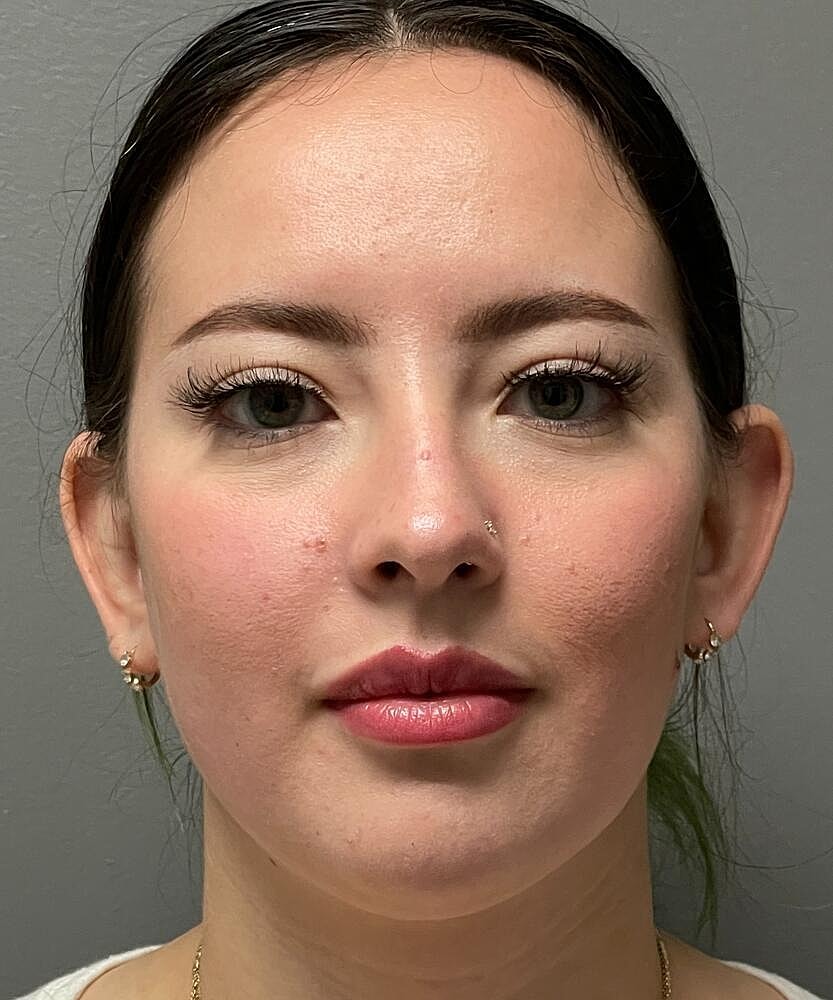 Rhinoplasty Before & After