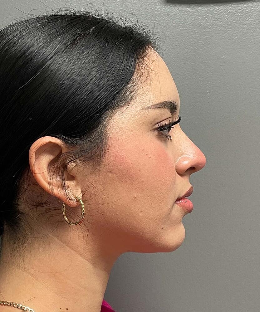 Rhinoplasty Before & After