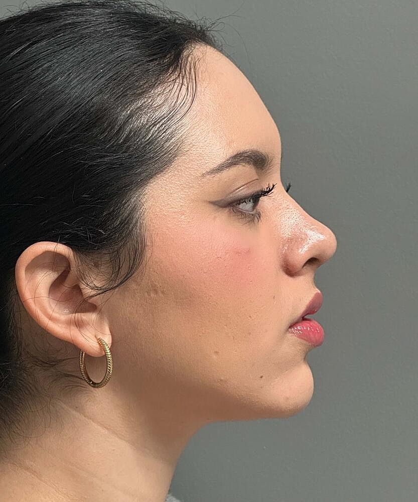 Rhinoplasty Before & After