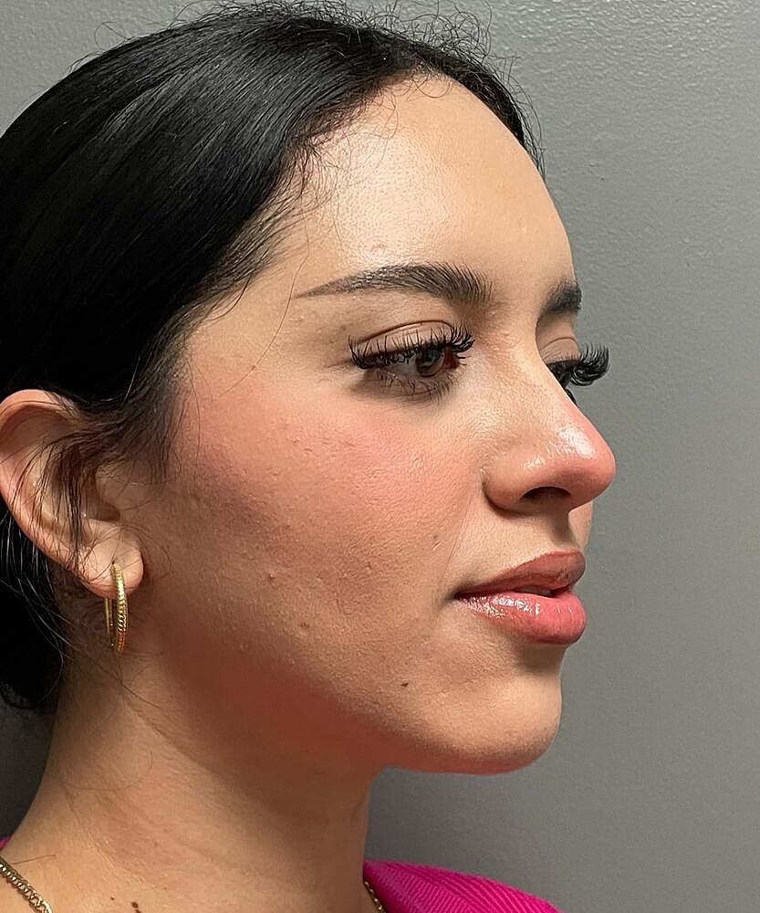 Rhinoplasty Before & After