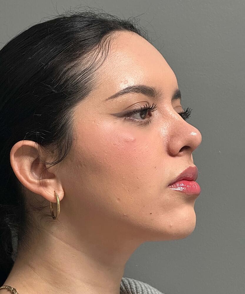 Rhinoplasty Before & After