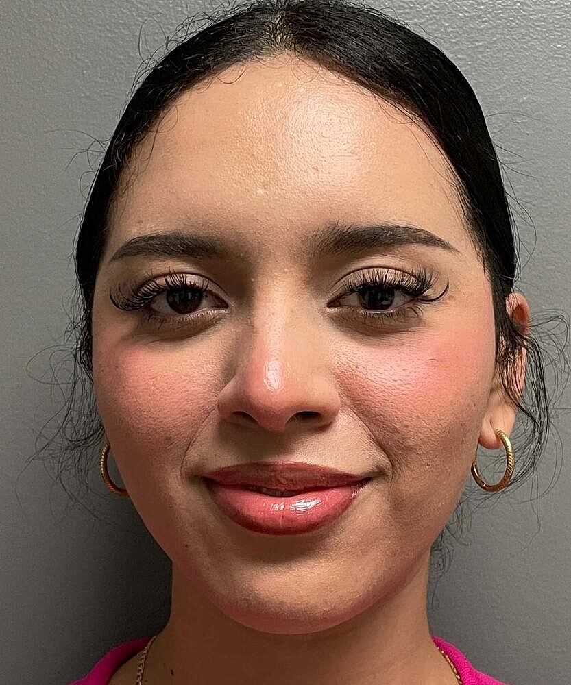 Rhinoplasty Before & After