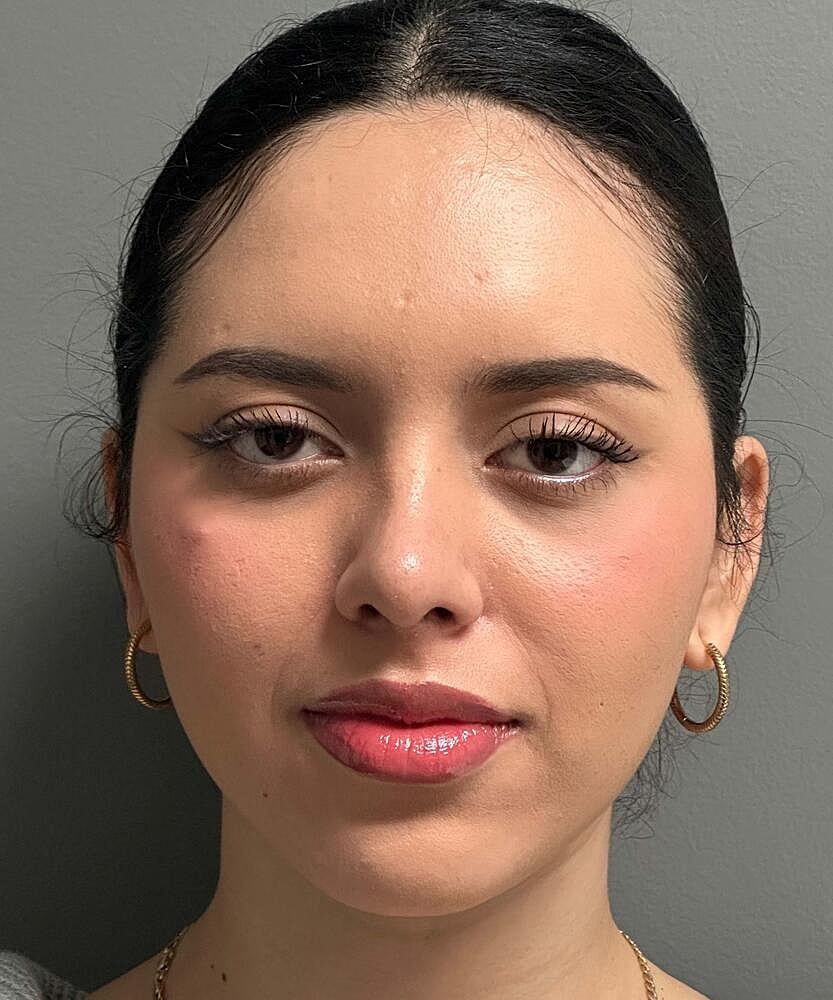 Rhinoplasty Before & After