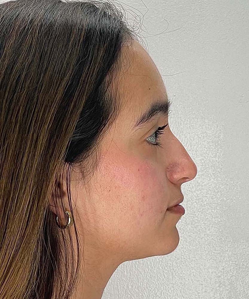 Rhinoplasty Before & After