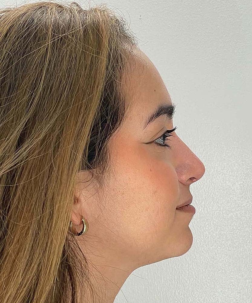 Rhinoplasty Before & After