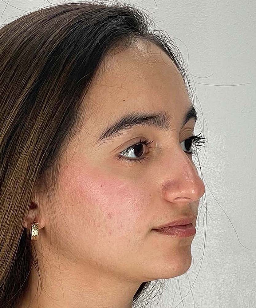 Rhinoplasty Before & After