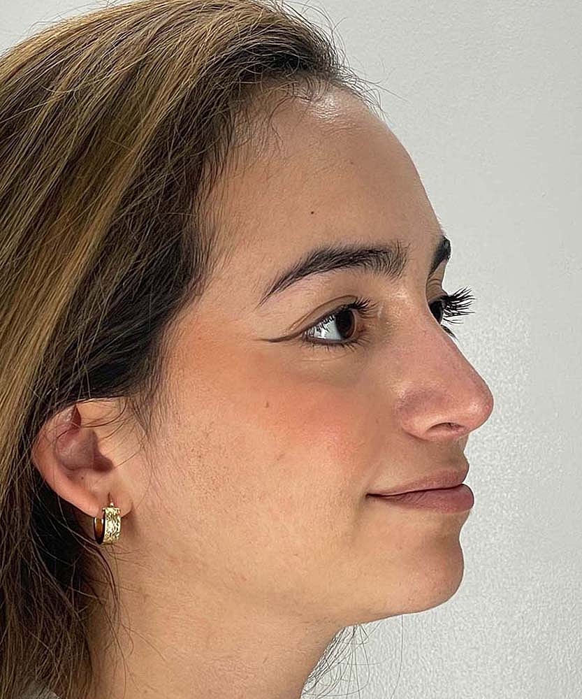 Rhinoplasty Before & After