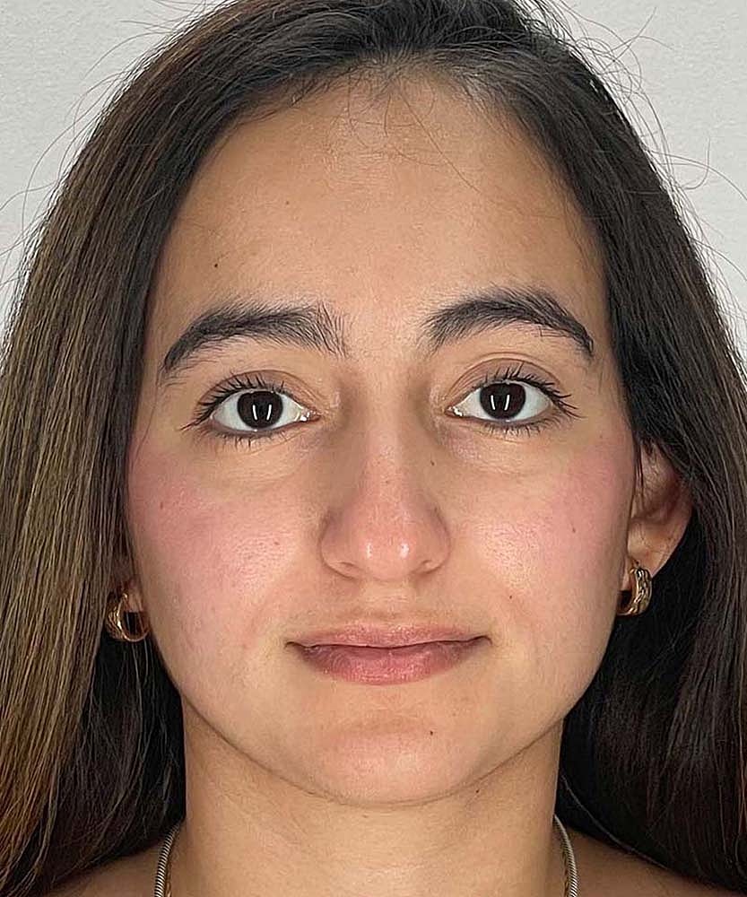 Rhinoplasty Before & After