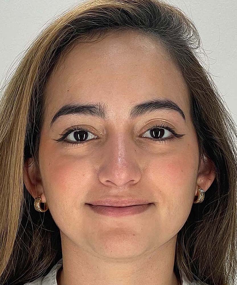 Rhinoplasty Before & After