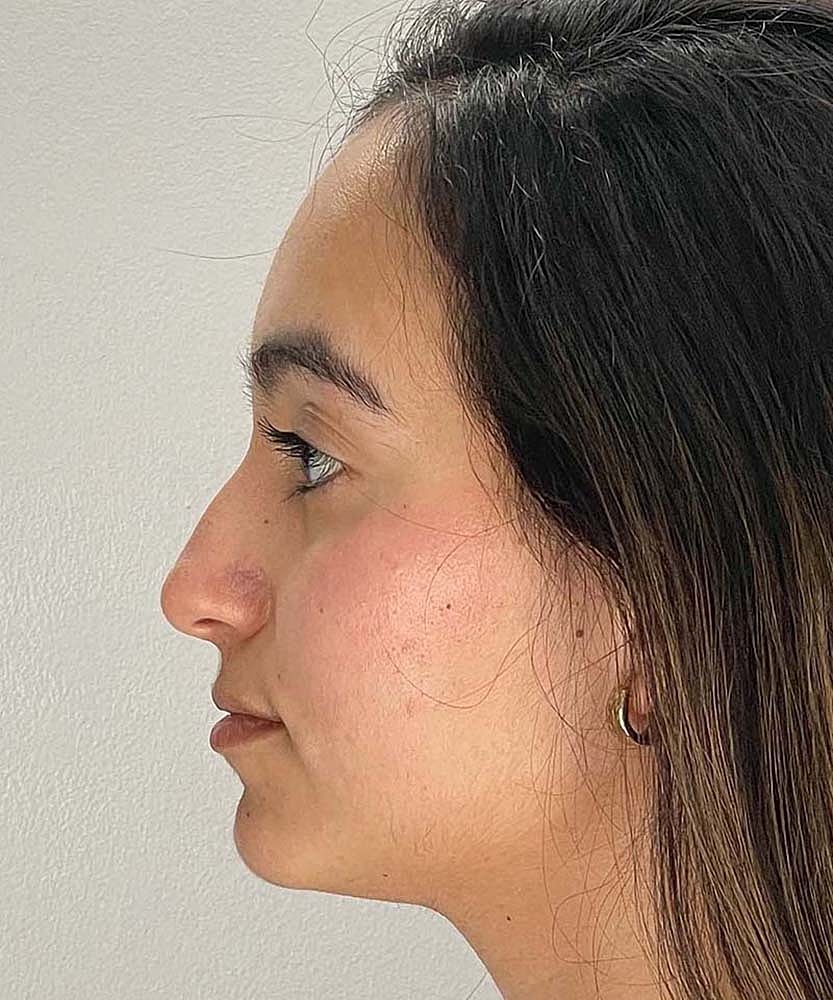 Rhinoplasty Before & After