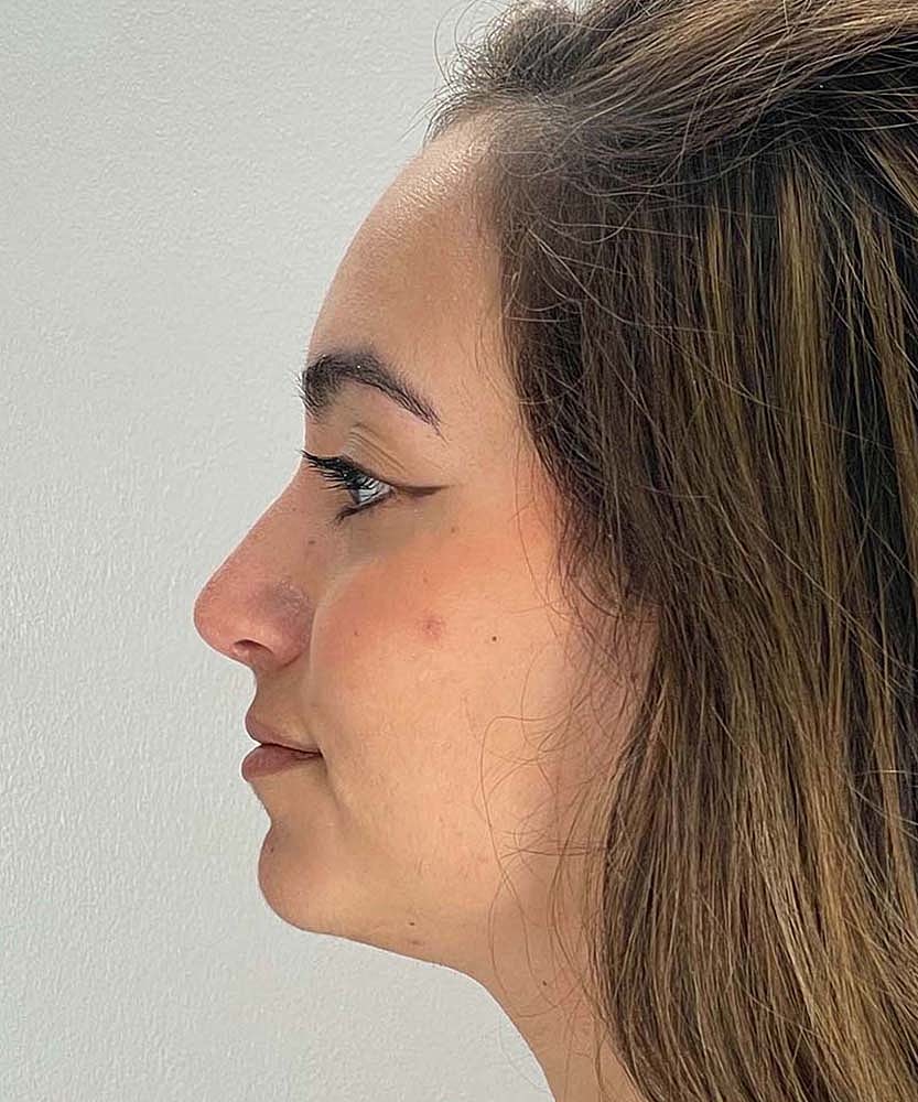 Rhinoplasty Before & After