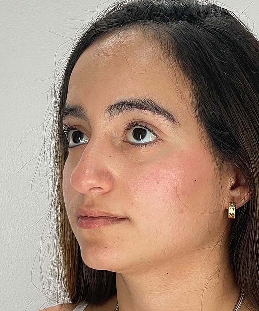 Rhinoplasty Before & After