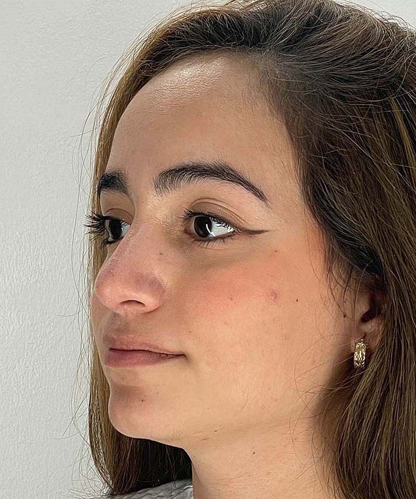 Rhinoplasty Before & After