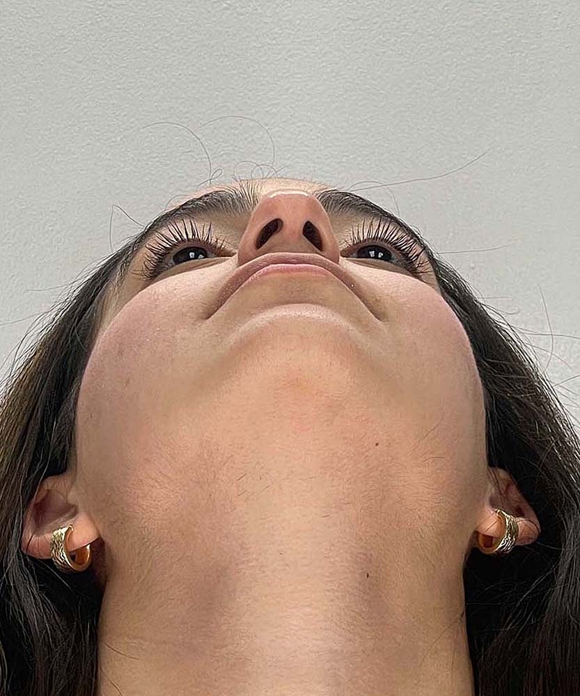 Rhinoplasty Before & After