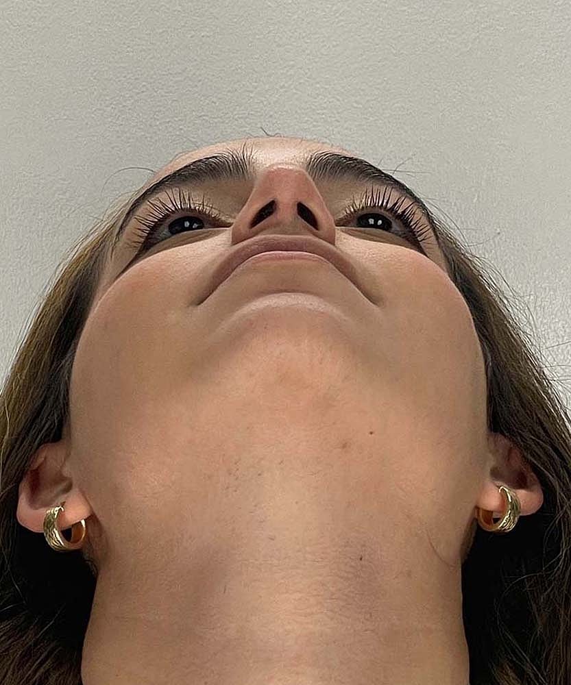 Rhinoplasty Before & After