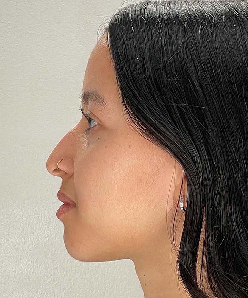 Rhinoplasty Before & After