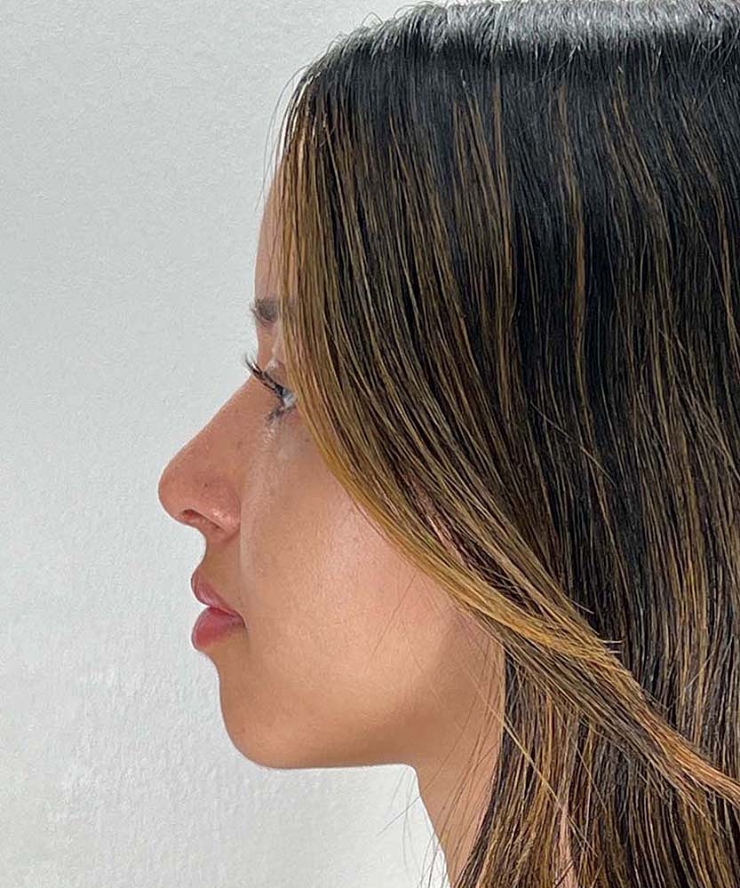 Rhinoplasty Before & After