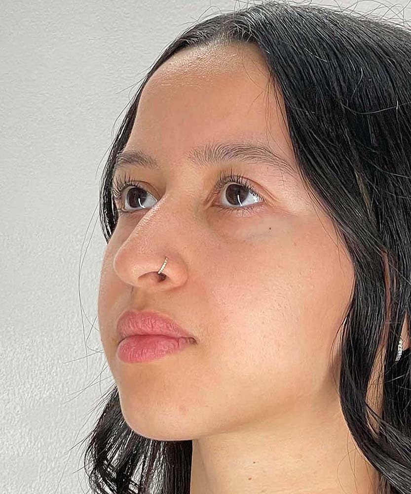 Rhinoplasty Before & After