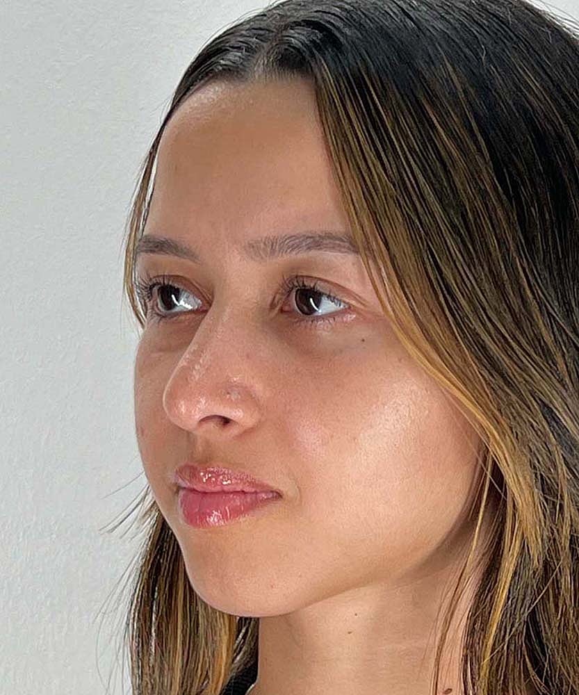 Rhinoplasty Before & After