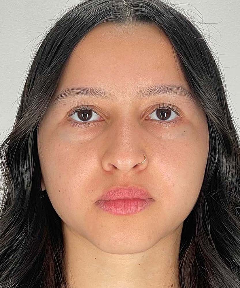 Rhinoplasty Before & After