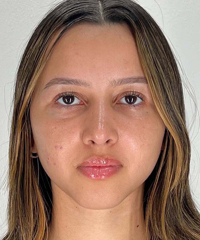 Rhinoplasty Before & After