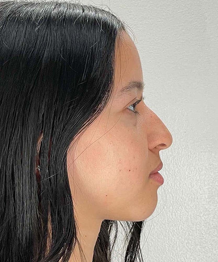 Rhinoplasty Before & After