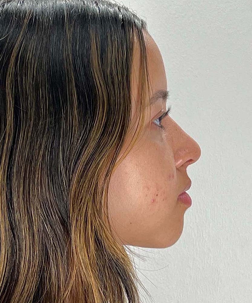 Rhinoplasty Before & After