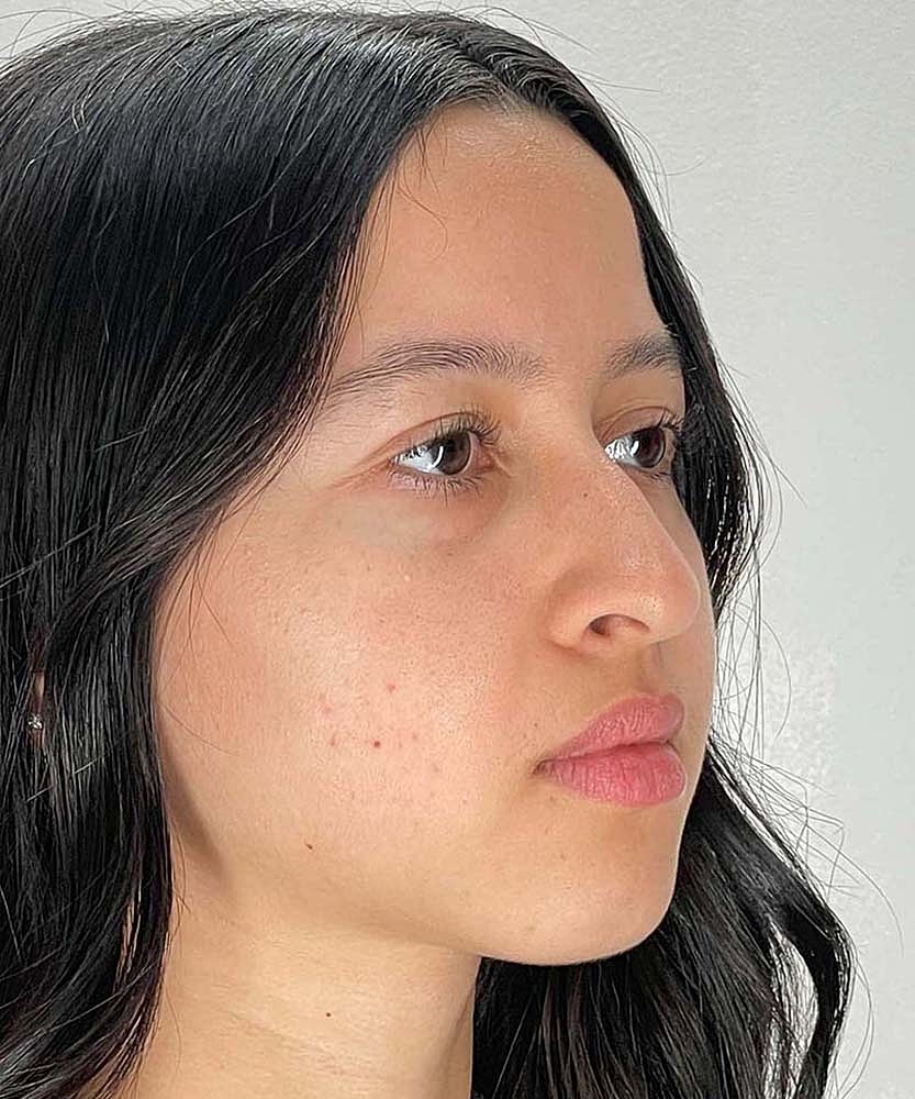 Rhinoplasty Before & After