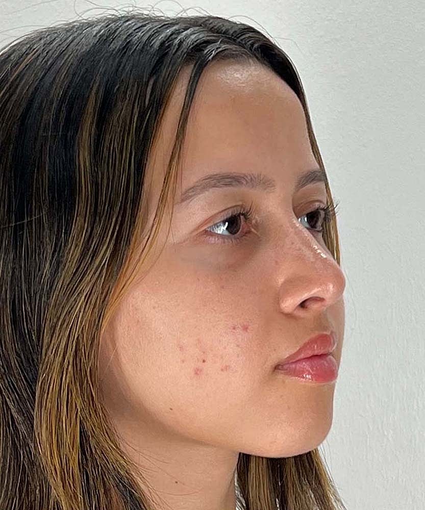 Rhinoplasty Before & After