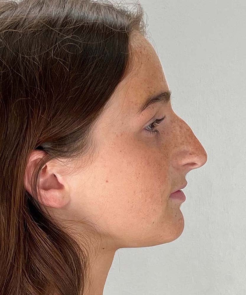 Rhinoplasty Before & After