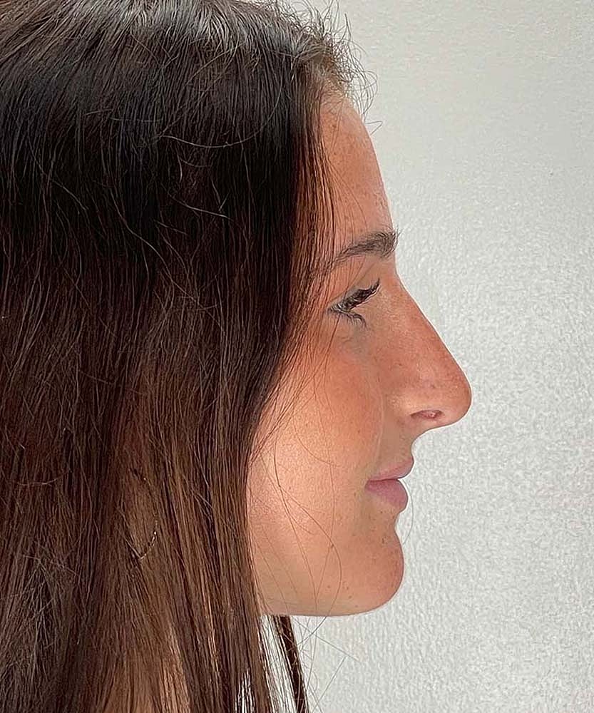 Rhinoplasty Before & After