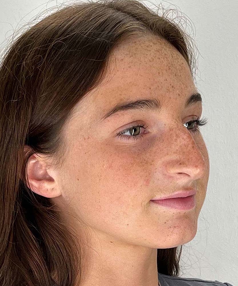 Rhinoplasty Before & After