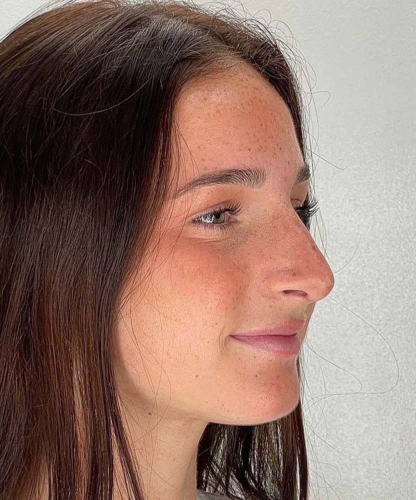 Rhinoplasty Before & After