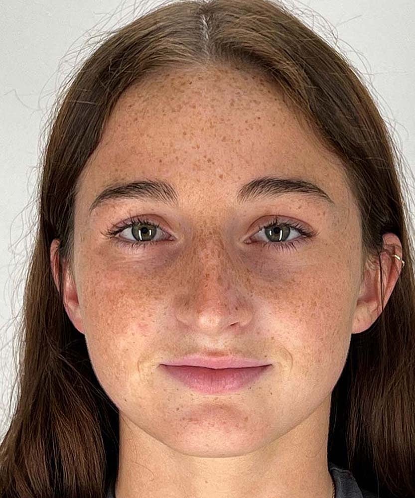 Rhinoplasty Before & After