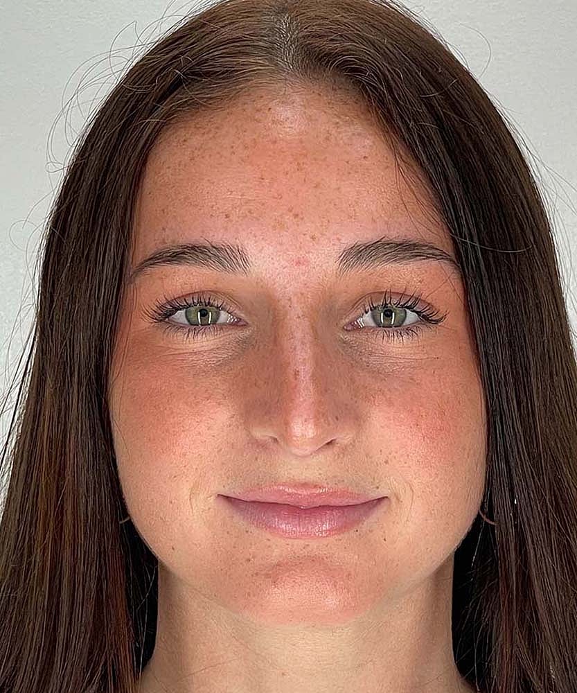 Rhinoplasty Before & After
