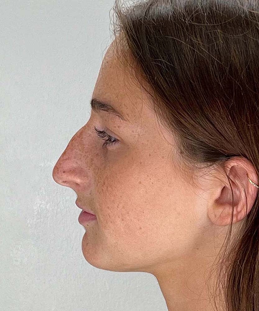 Rhinoplasty Before & After