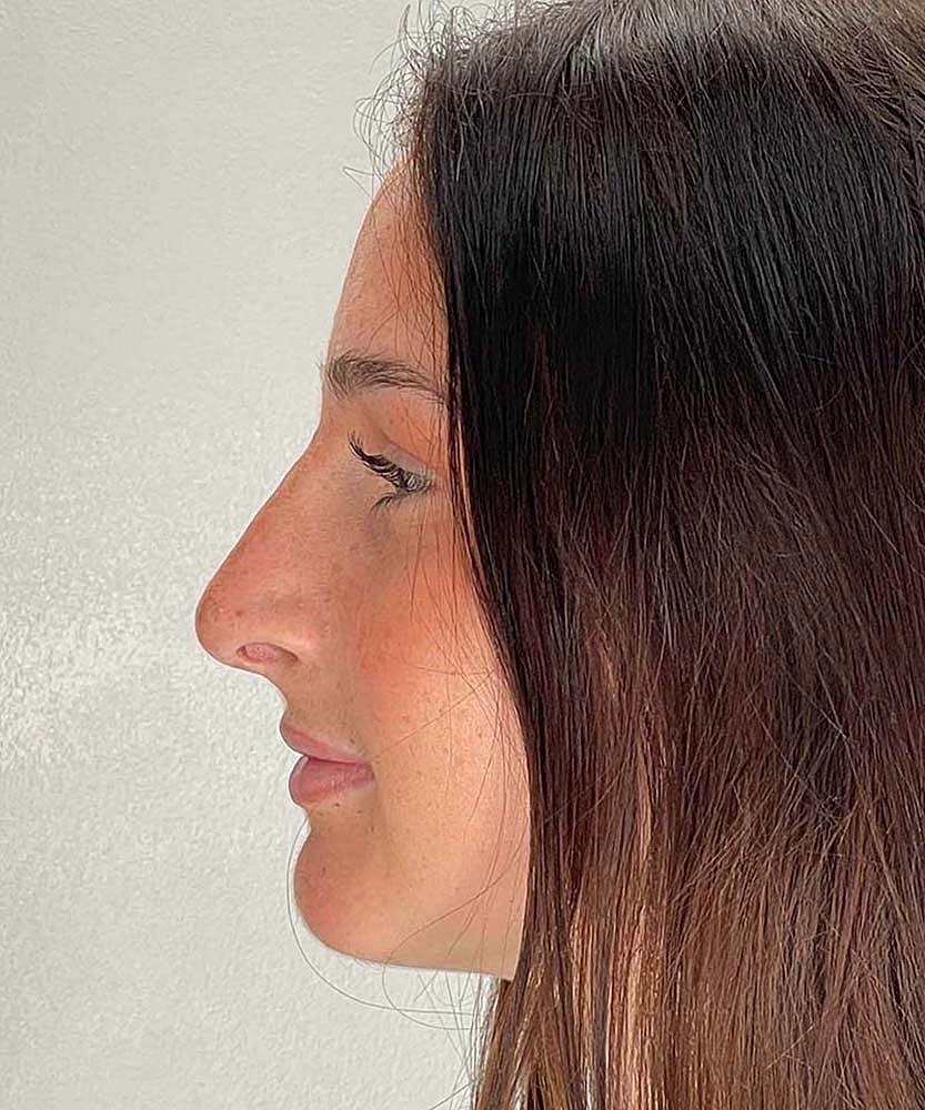 Rhinoplasty Before & After