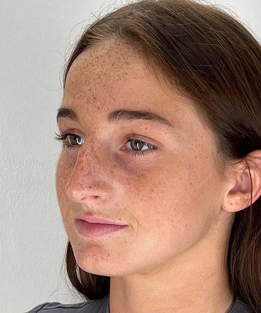 Rhinoplasty Before & After