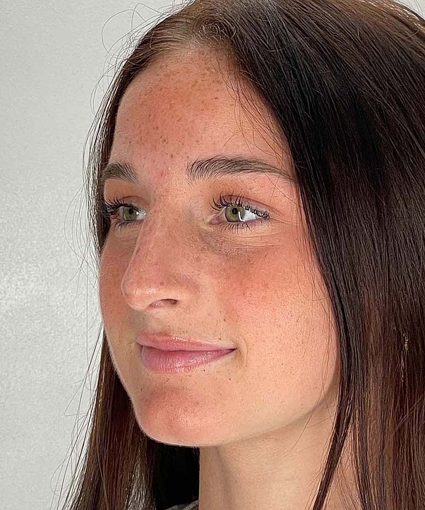 Rhinoplasty Before & After